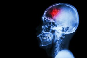 The Long-Term Effects of a Brain Injury
